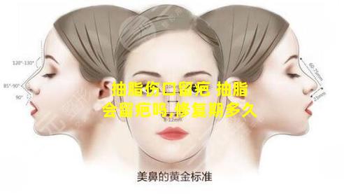 抽脂伤口留疤 抽脂会留疤吗,修复期多久